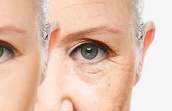 Anti-aging procedures