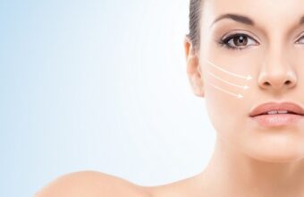 Face and neck lift (rhytidectomy)